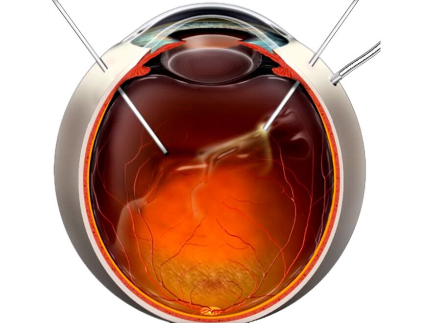 Vitrectomia - Erretinako esfoliazioa denean jendeari erakutsitako prozedura